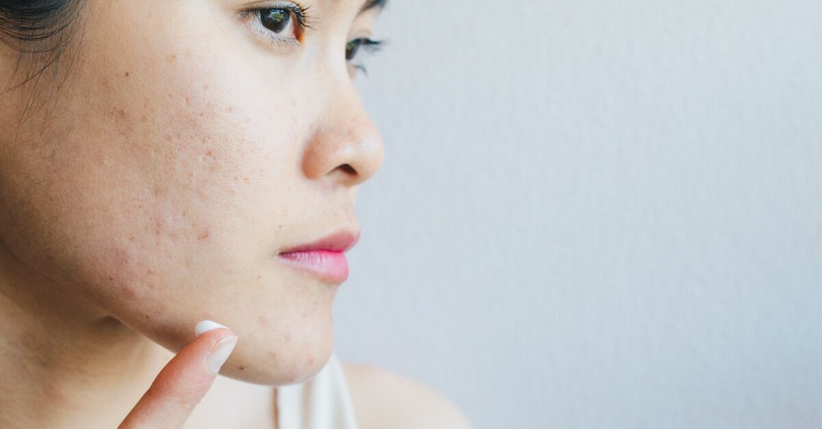 Acne skin 5 best sale deep