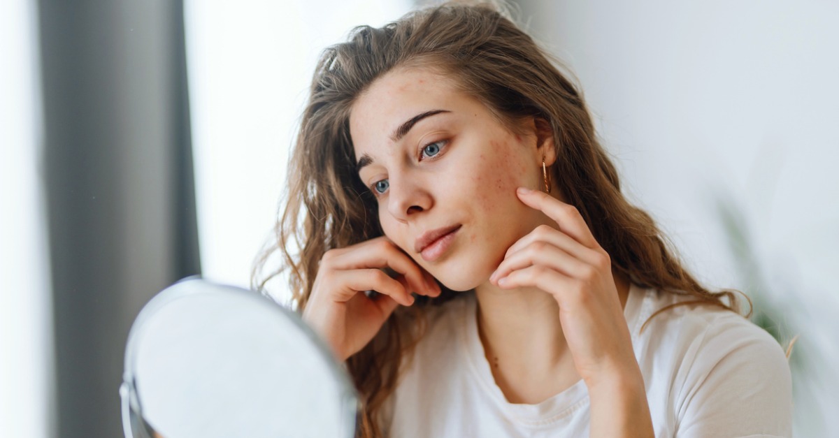 Could Your Acne Affect Your Mental Health?