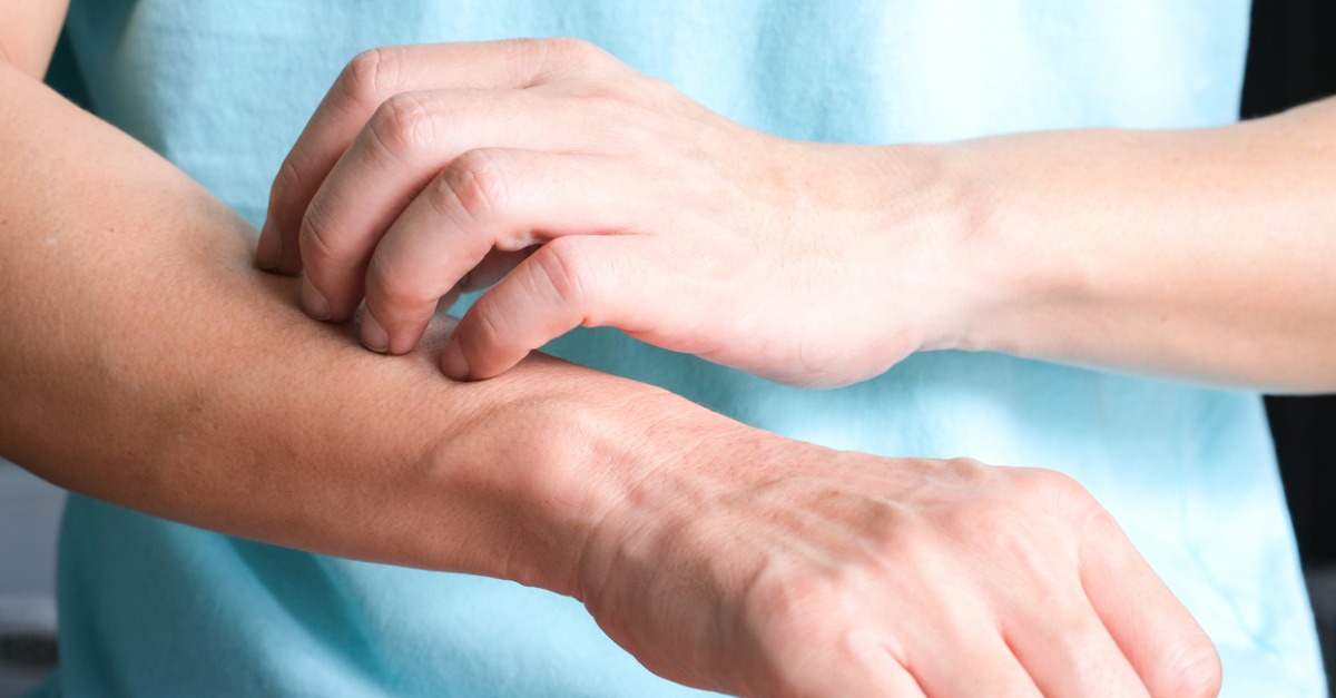 Four Ways to Reduce Psoriasis Flare-Ups