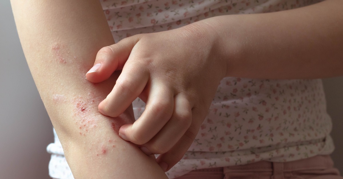 Learn Your Eczema Triggers