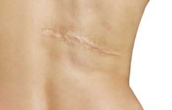 Understanding Keloid Scars