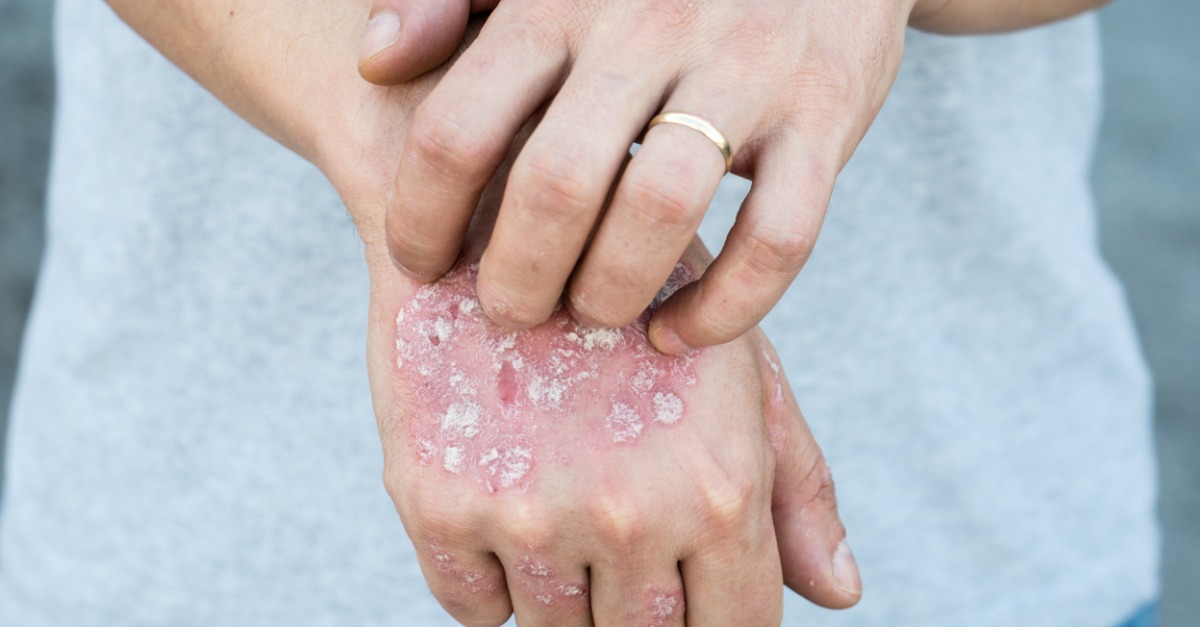Psoriasis: The Importance of a Treatment Plan