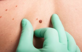 Have You Checked Your Moles Recently?