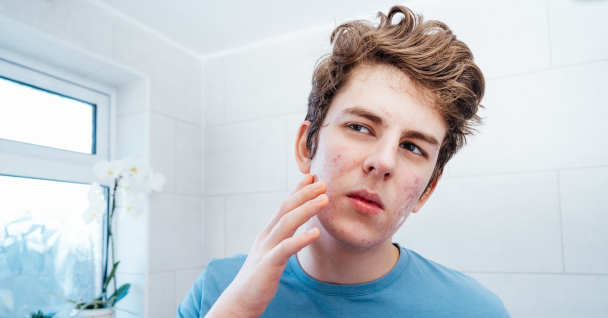 Do We Need a Dermatologist for My Teenager’s Acne?