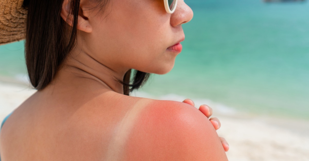 Sunburn: An Irreversible but Preventable Damage