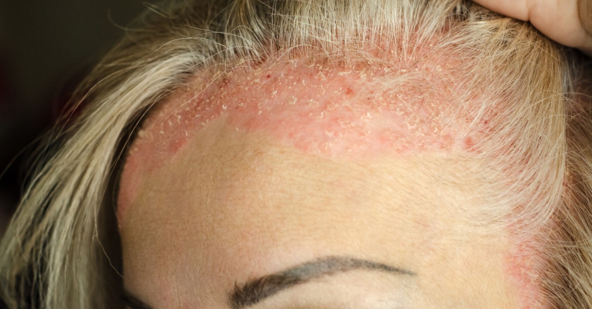 Psoriasis: Overview