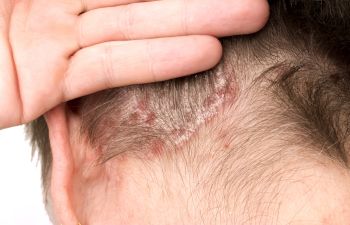 🥇 Understanding Your Itchy Scalp - Olansky Dermatology & Aesthetics