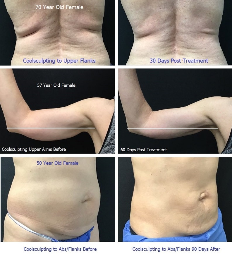 atlanta-coolsculpting-before-after-photos