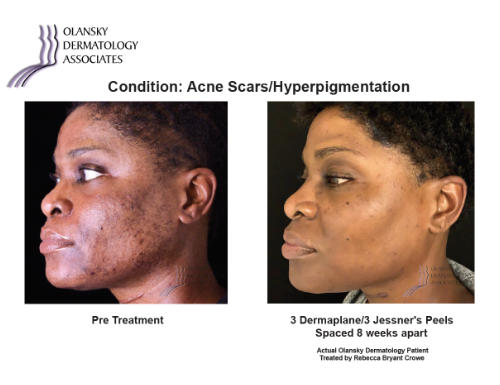 hyperpigmentation treatment dermatologist
