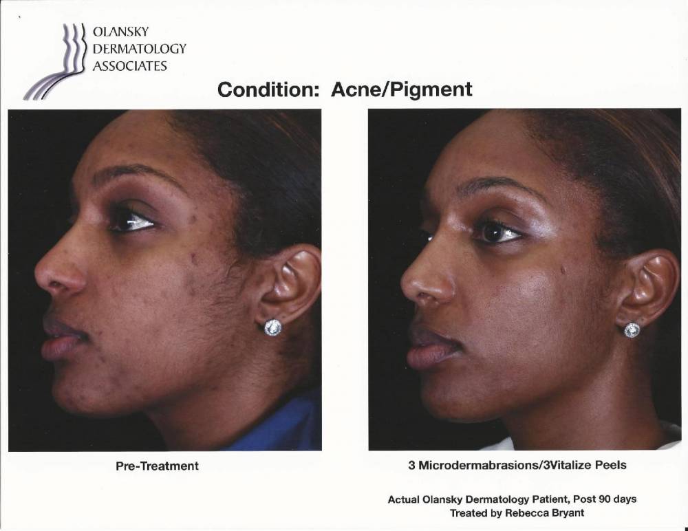 hyperpigmentation dermatology