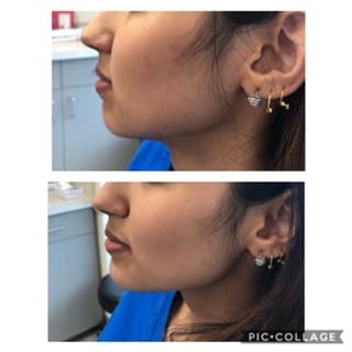Before and After Botox for Jawline Reshaping Procedure