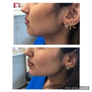 Female Patient Before and After Botox for Jawline Reshaping Procedure