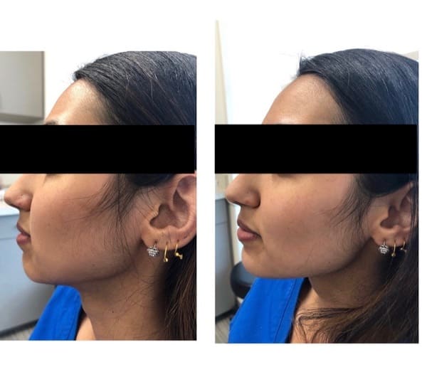 Female Patient Before and After Botox for Jawline Reshaping Procedure