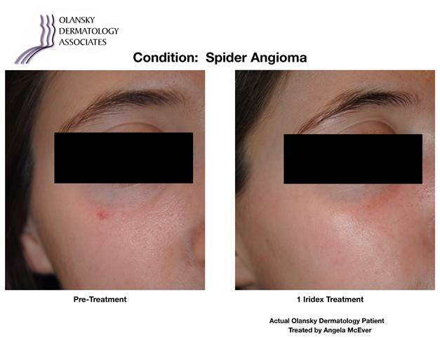 Atlanta Cherry Angioma Before And After Photos 