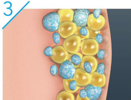Partially eliminated frozen cells of stubborn fat shortly after CoolSculpting procedure.