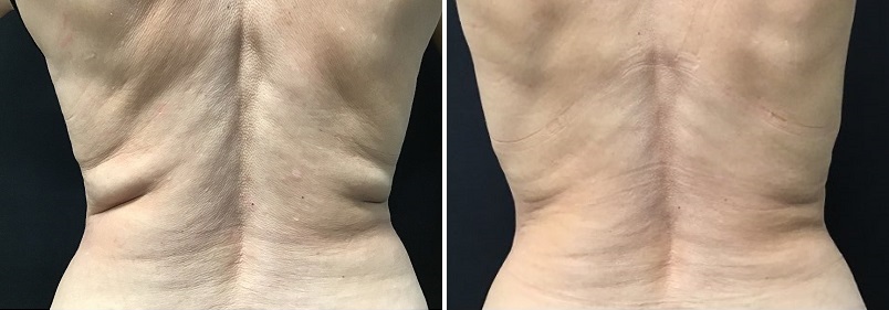 CoolSculpting Before and After Picture of Back Fat and Stomach -  Connecticut Skin Institute