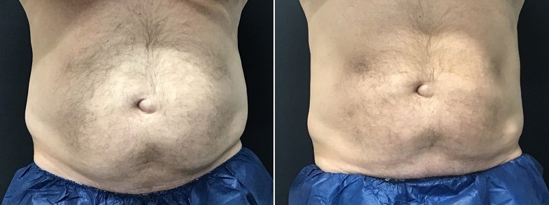 6 Cycles to Abs Before (left) - 90 Days After With No Weight Loss (right)