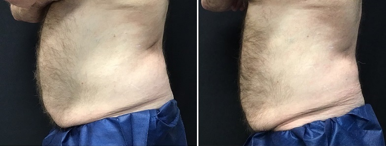 6 Cycles to Abs Before (left) - 90 Days After With 12lb Weight Loss (right)