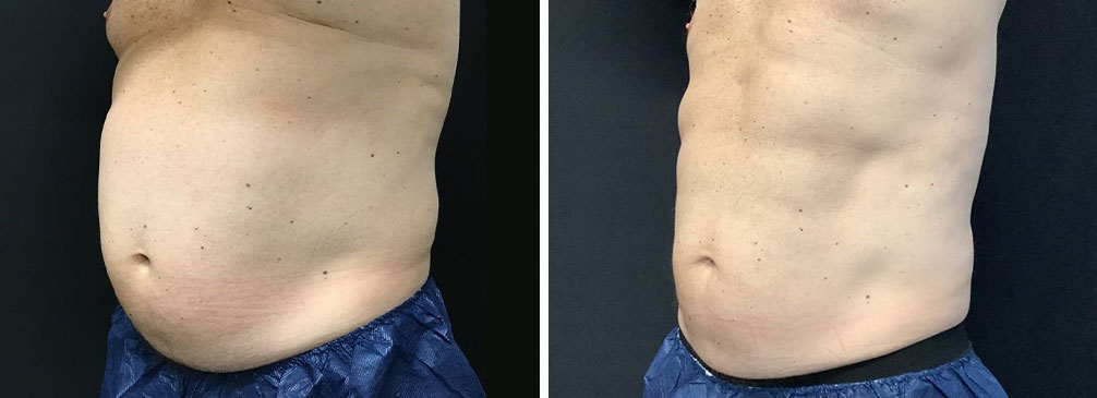 Coolsculpting Gallery Olansky