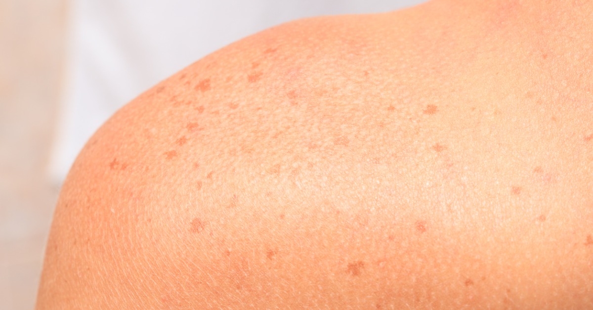 🥇 What Causes Sunspots and How Are They Treated?