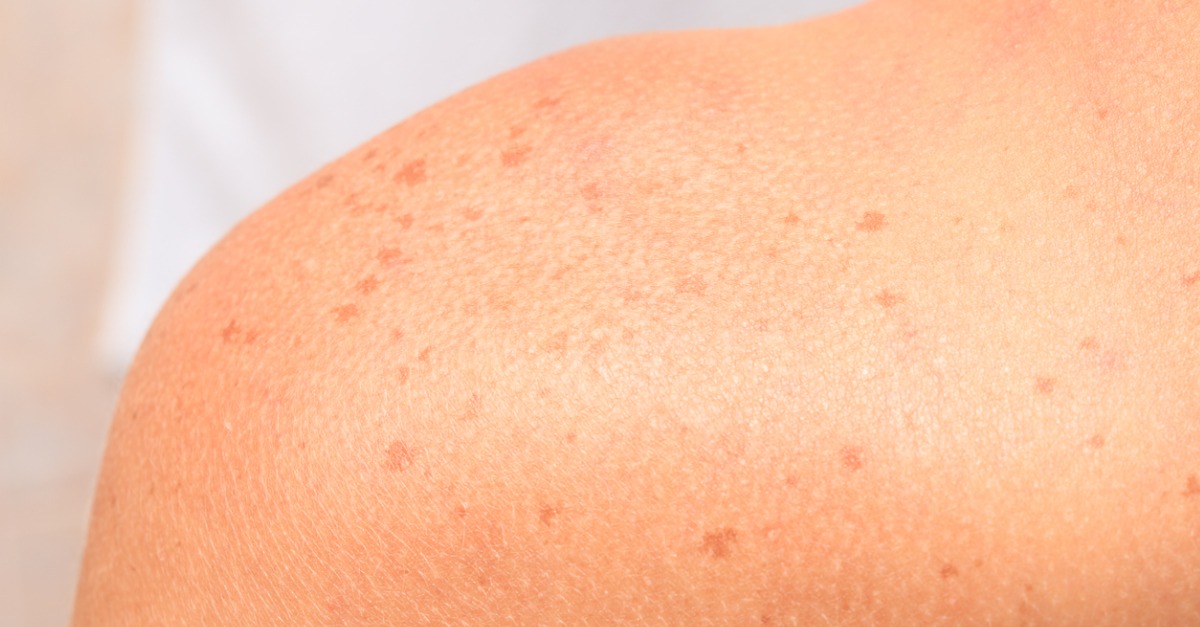 Brown Skin Spots - When not to worry about the brown spots on your