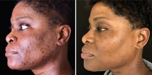 Before and after of 3 Dermaplane/3 Jessner’s Peel spaced 8 weeks apart