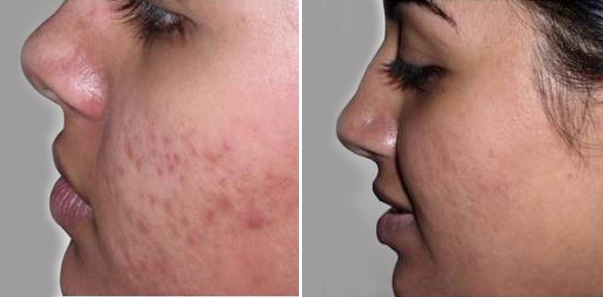 Before and after 6 microdermabrasions and 6 vitalize peels