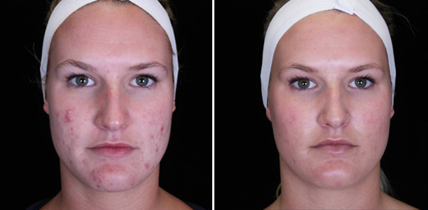 Conditions: Acne and Hyperpigmentation