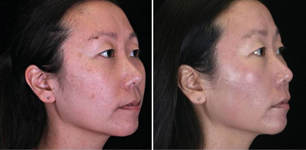 Before and after 4 Rejuvapens/3 Microderms/3 Vitalize Peels