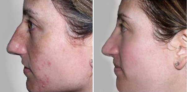 Before and After 5 microdermabrasions/6 vitalize peels