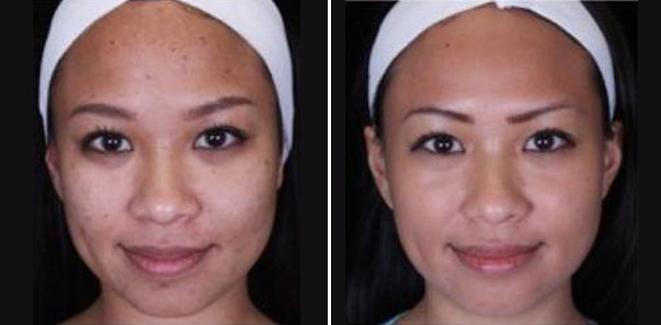 Before and after 3 microdermabrasions/3 vitalize peels