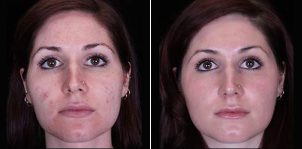 Before and after 3 Microdermabrasions/3 Vitalize Peels/2 Rejuvapens