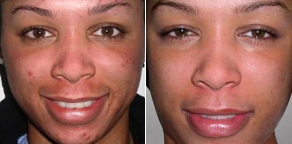 Before and after 6 Microdermabrasions/6 Vitalize Peels