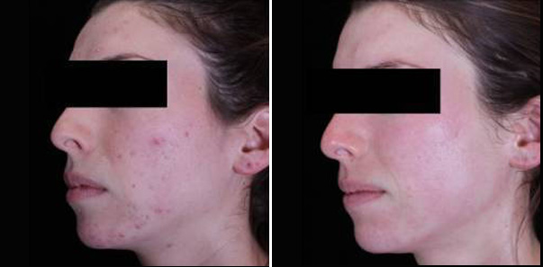 Before and after 3 Microdermabrasions/3 Vitalize Peels