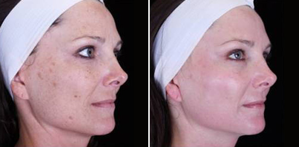 Before and after treatment for sun spots, texture, and tone.