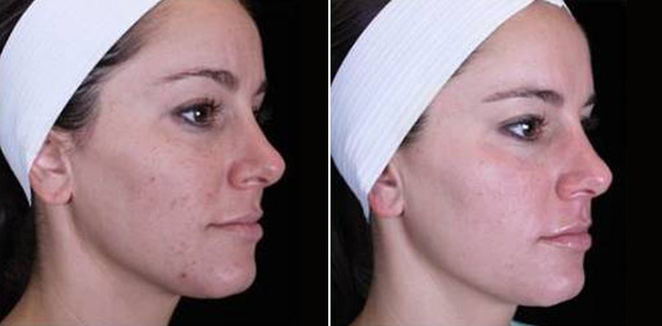 Before and after treatment for hyperpigmentation, texture, and tone
