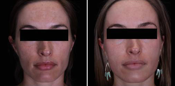 Before and after melasma and hyperpigmentation treatment