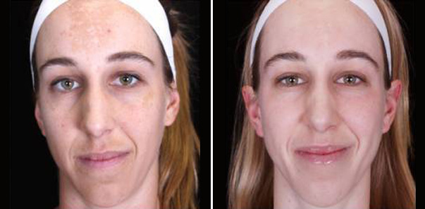 Before and after melasma and hyperpigmentaton treatment