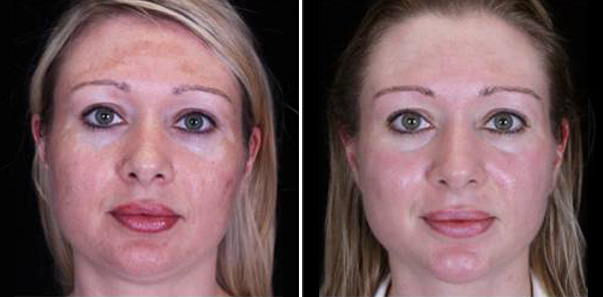 Before and after pictures of hyperpigmentation treatment