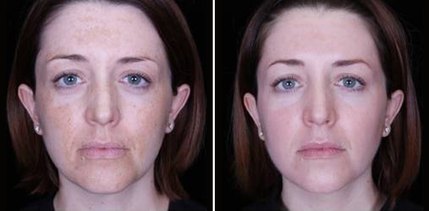 Before and after Melasma and Pigment treatment