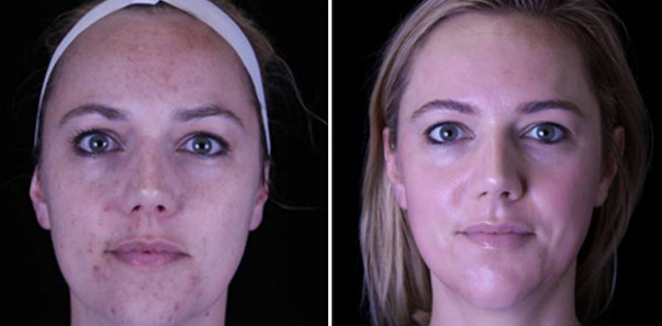 Before and after treatment for melasma, sun spots, and acne scarring
