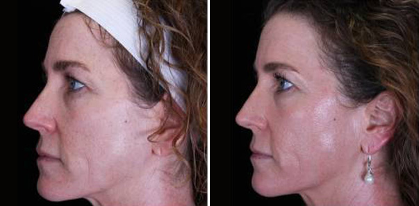 Before and after treatment for pigment, texture, and tone.