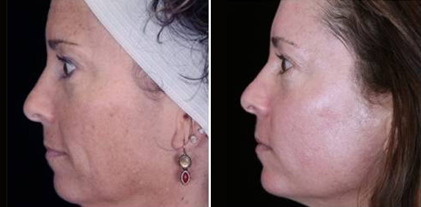 Before and after treatment for fine lines, wrinkles, and pigment.