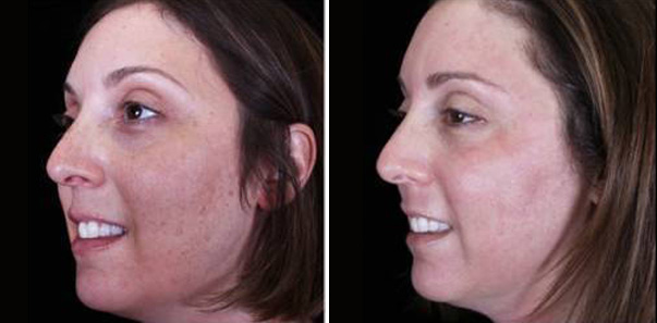 Before and after treatment for hyperpigmentation, texture, and tone