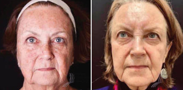 Before after treatment for sun spots, fine lines, and wrinkles.