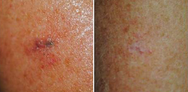 Before and after - red blood vessels treatment