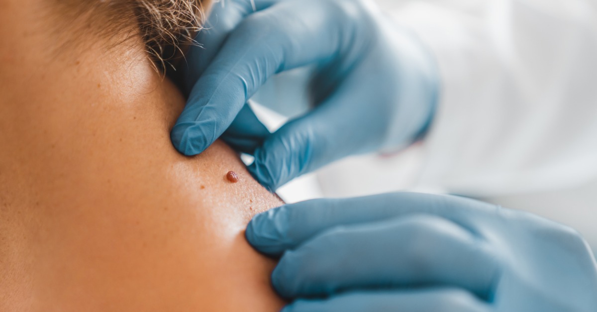close up of mole being removed