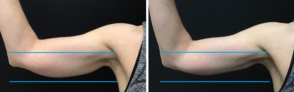 Coolsculpting Upper Arms Before (left) - 60 Days Post Treatment (right)