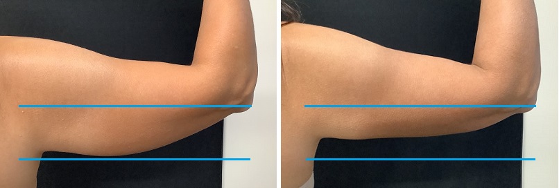 Coolsculpting Upper Arms Before (Left) 120 Days Post 2nd Treatment with 5lb Weight Loss and Body Firm lotion (Right)