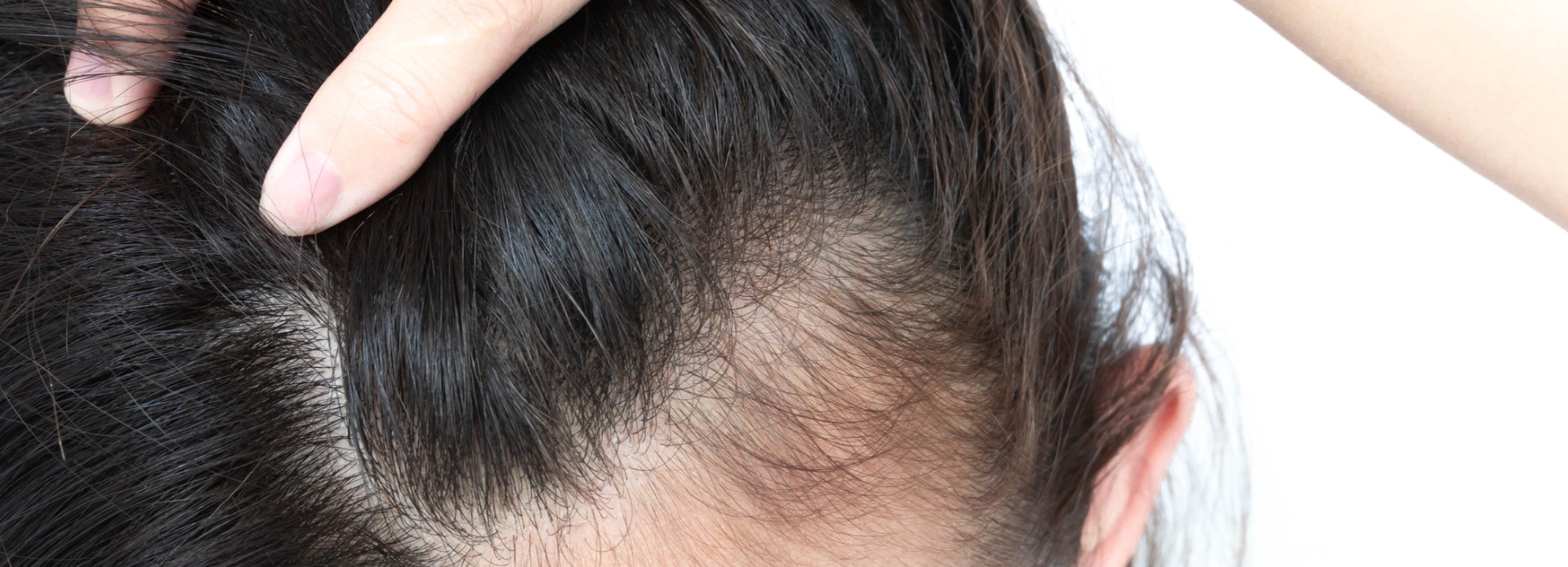 🥇 PRP for Hair Loss - Olansky Dermatology & Aesthetics